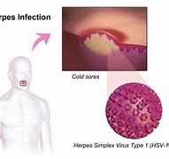 Image result for Genitals Herpes Pictures in Men