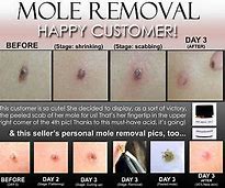 Image result for Wart Freeze On a Mole