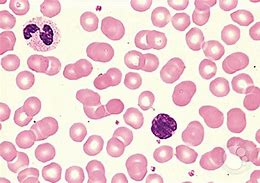Image result for T-cell Lymphoma Sezary Syndrome