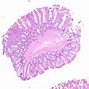 Image result for How Big Is 6Mm Tumor