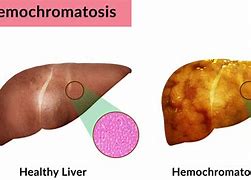 Image result for hemocromatosis