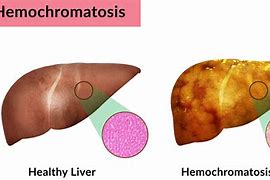 Image result for hemodromatosis
