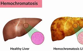 Image result for hemocr9matosis