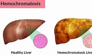 Image result for hemocrpmatosis