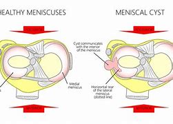 Image result for Meniscal Cyst Ultrasound