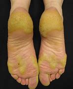 Image result for Infected Corn On Foot