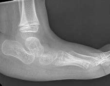 Image result for Bumps On Bottom of Feet