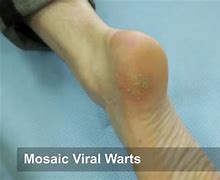 Image result for OTC Wart Treatment