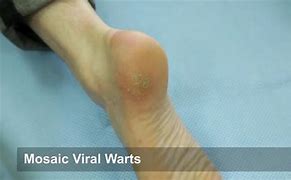 Image result for Cryotherapy Wart Removal