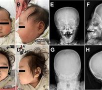 Image result for Microcephaly Skull