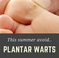 Image result for What Causes Plantar Warts