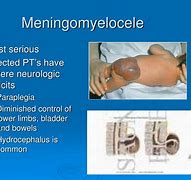 Image result for Meningocele and Myelomeningocele Gross Image