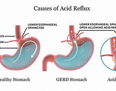 Image result for Acid Reflux and Jaw Pain