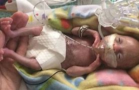 Image result for Anencephaly Diagnosed Aborted