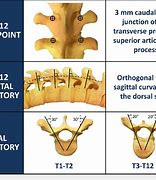 Image result for Lower Thorasic Spine Screw Placement