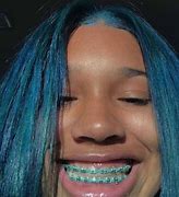 Image result for Braces Colors for Summer