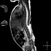 Image result for Terminal Myelocystocele