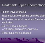 Image result for Chest Tube Thoracostomy