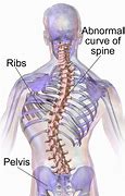Image result for Crooked Posture