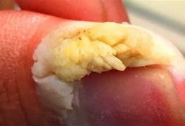 Image result for Warts On Kid's Hands