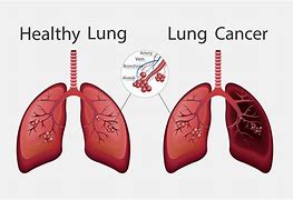 Image result for Normal Healthy Lungs