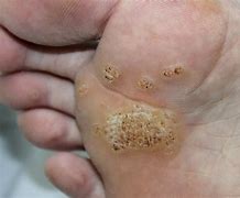 Image result for HPV Wart Removal