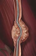 Image result for Ureteral Stent vs Nephrostomy Tube