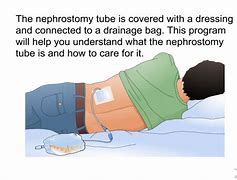 Image result for Percutaneous Nephrostomy Tube Bag