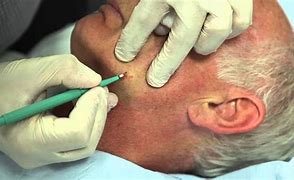 Image result for Cautery Skin Cancer