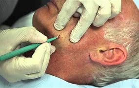 Image result for Face Warts Treatment