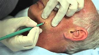 Image result for Face Wart Removal