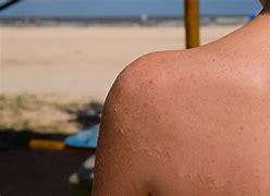 Image result for Beach Sun Burn Treatment