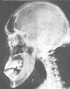Image result for scromegalia