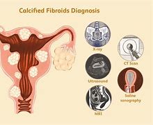 Image result for Calcified Fibroid Uterus