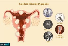 fibroids 的图像结果