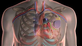 Image result for CRT Device Heart