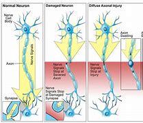 Image result for Neuron Damage