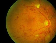 Image result for Cotton-Wool Spots in Eyes