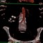 Image result for Complex Cyst with Mural Calcifictaions Ultrasound Kidney