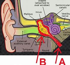 Image result for Inner Ear Disease