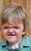 Image result for Apert Syndrome