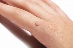 Image result for Common Warts On Fingers