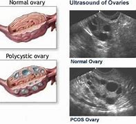 Image result for Cyst On Ovaries with Teeth and Hair