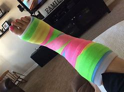 Image result for Two Leg Casts