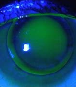 Image result for Piggyback Lenses for Keratoconus