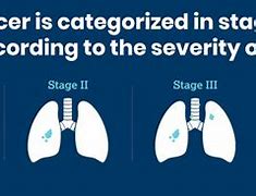 Image result for Stage 1B Lung Cancer