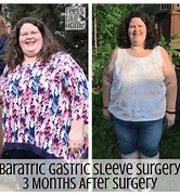 Image result for 5 Years After Gastric Sleeve