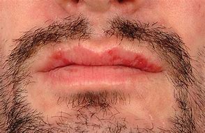 Image result for Pustular Syphilis