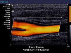 Image result for Carotid Ultrasound Power Doppler