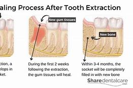 Image result for Instructions After Tooth Extraction